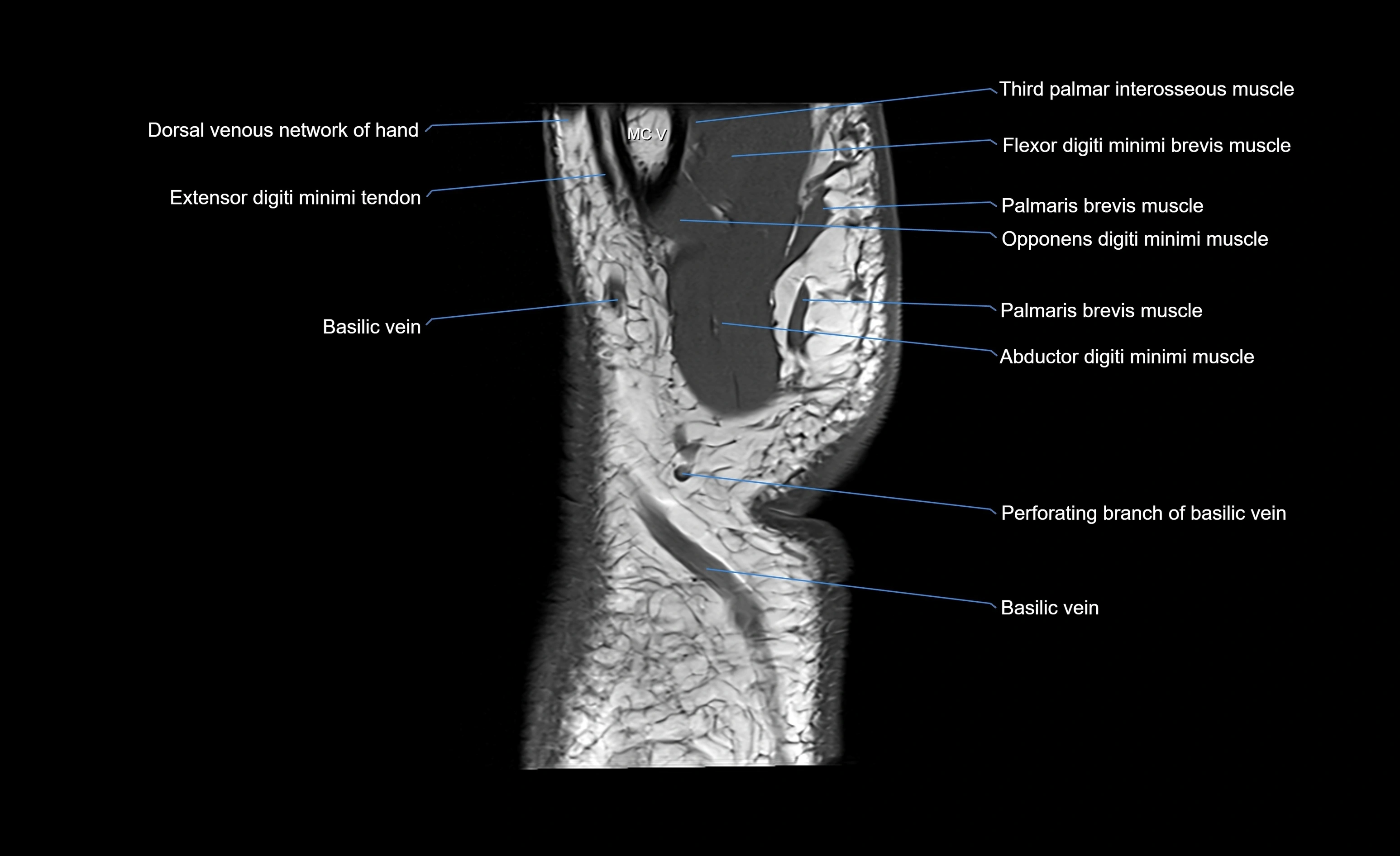 MRI wrist sagittal cross sectional anatomy 3T  radiology  image-img-00001-00025.webp